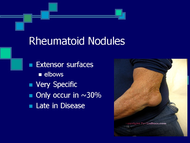 Rheumatoid Nodules Extensor surfaces elbows Very Specific Only occur in ~30% Late in Disease
